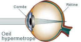 oeil hypermetrope