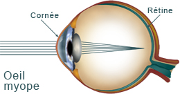 oeil myope